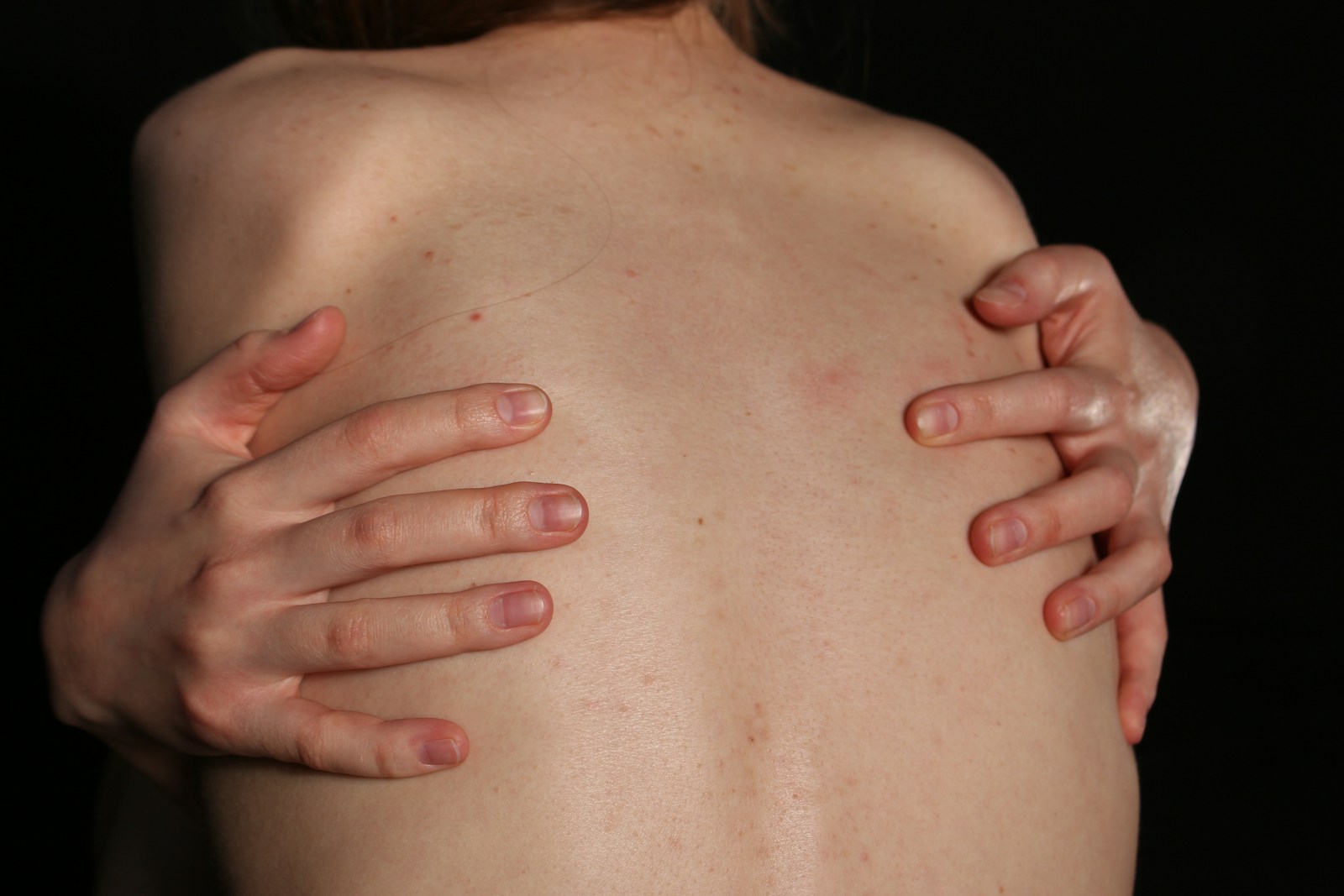 A person embraces their back with both hands. postherpetic neuralgia pen chronic pain